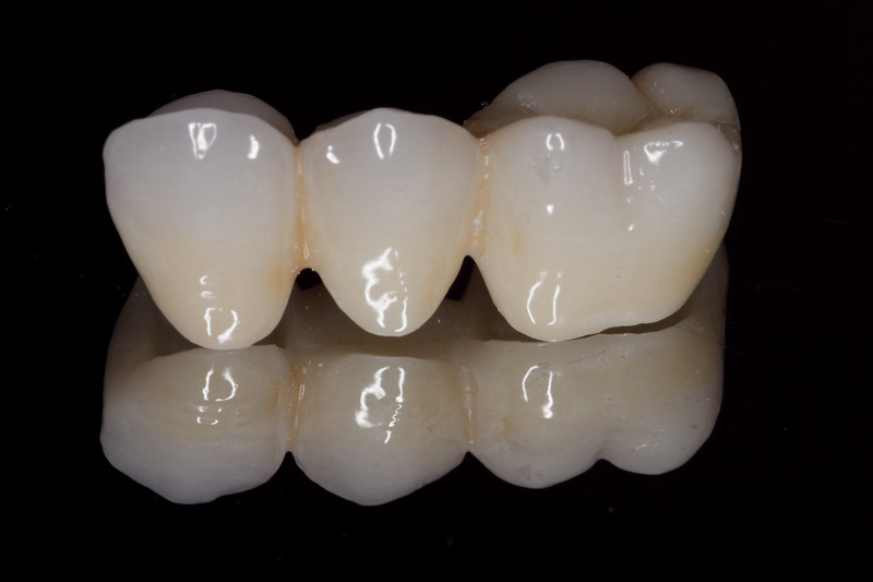 â € œdental zirkonia brug â € ś å> ¾ç ‰ ‡ æ œç' ¢ ç »
